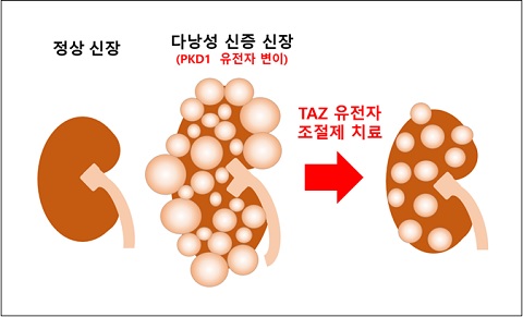 다낭성 신증에서 낭종 발생 및 크기 조절하는 TAZ 유전자 발견