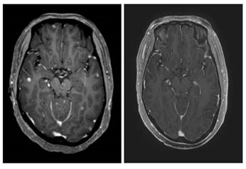 타그리소 복용 전(좌)과 복용 3개월 후(우) CT 사진. 하얀색이던 암 조직이  확연히 줄어들었다.